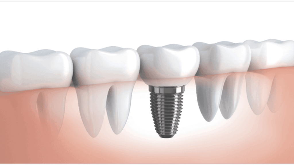 All About Dental Implants | Happy Smiles Dental