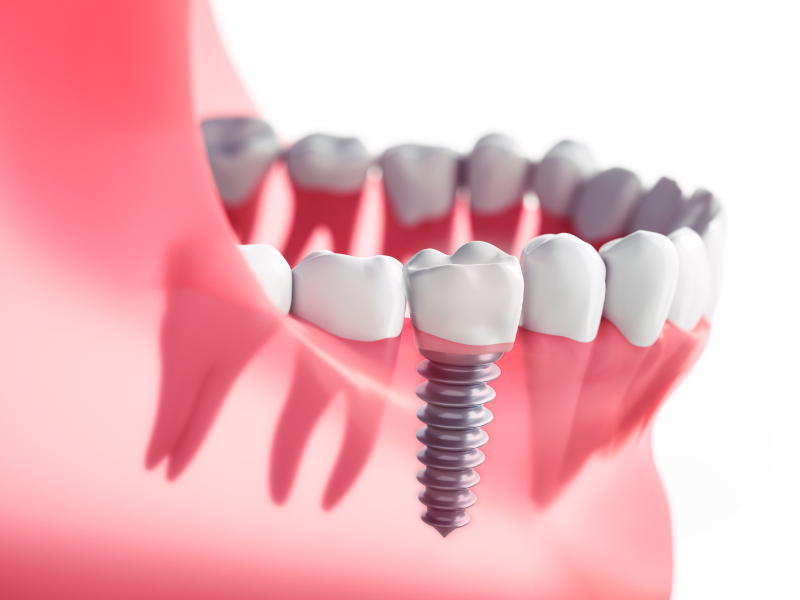 Restore Missing Teeth with Dental Implants | Happy Smiles Dental