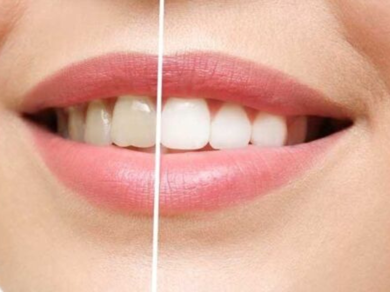 Convenient Teeth Whitening Solutions | Happy Smiles Dental