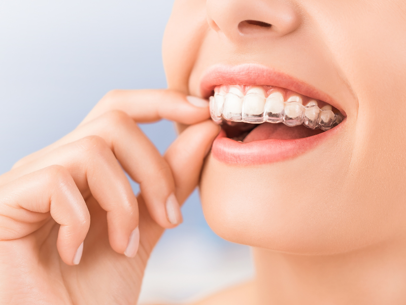 Affordable invisalign Dental Care in Washington Maryland | Happy Smiles Dental