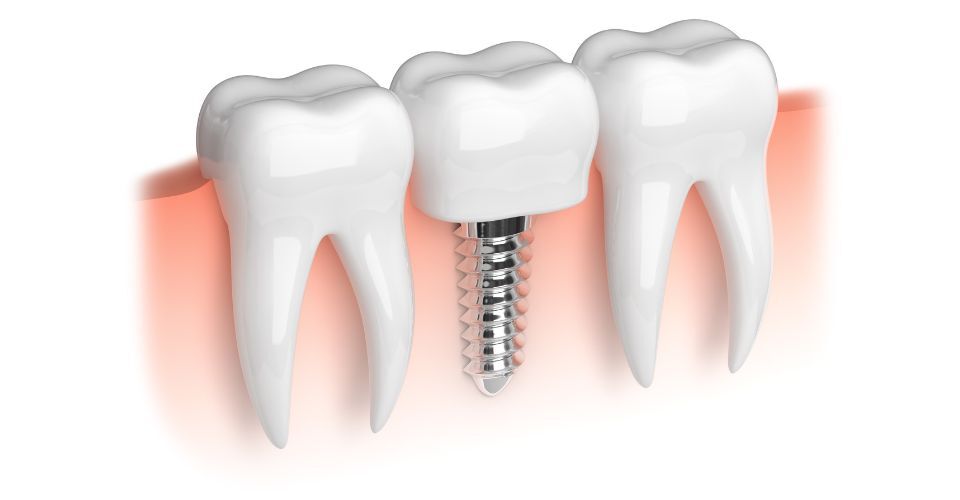Dental Implants | Happy Smiles Dental